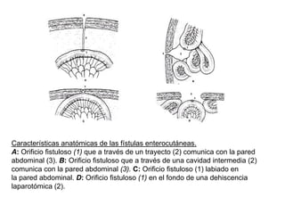 Características anatómicas de las fístulas enterocutáneas.
A: Orificio fistuloso (1) que a través de un trayecto (2) comunica con la pared
abdominal (3). B: Orificio fistuloso que a través de una cavidad intermedia (2)
comunica con la pared abdominal (3). C: Orificio fistuloso (1) labiado en
la pared abdominal. D: Orificio fistuloso (1) en el fondo de una dehiscencia
laparotómica (2).
 