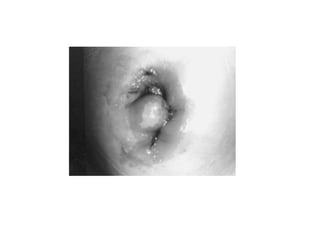 fistulas enterocutaneas