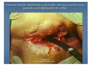 fistulas perianales