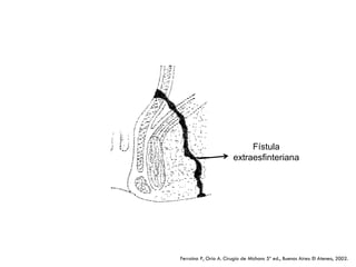 Fístula
                        extraesfinteriana




Ferraina P, Oría A. Cirugía de Michans 5ª ed., Buenos Aires: El Ateneo, 2002.
 