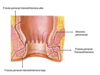 Fístula perianal interesfinteriana alta




                                            Absceso
                                            pelvirrectal




                                            Fístula perianal
                                           Transesfinteriana




 Fístula perianal interesfinteriana baja
 