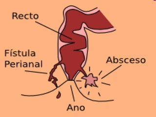 fistulas perianales