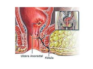 fistulas perianales