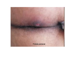 fistulas perianales