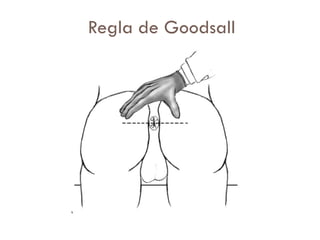 Regla de Goodsall
 