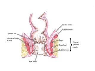 fistulas perianales