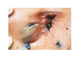fistulas perianales