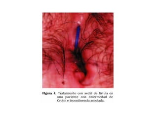fistulas perianales
