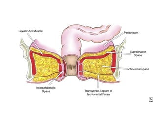 fistulas perianales