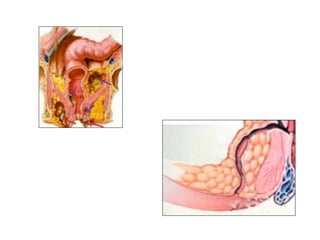 fistulas perianales