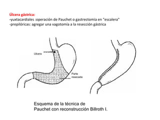 Úlcera gástrica:
‐yuxtacardiales :operación de Pauchet o gastrectomía en "escalera"
‐prepilóricas: agregar una vagotomía a la resección gástrica




              Ulcera




                                     Parte
                                     resecada




              Esquema de la técnica de
              Pauchet con reconstrucción Billroth I.
 