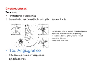 Úlcera duodenal:
Tecnicas:
   antrectomía y vagotomía
   hemostasia directa mediante antropiloroduodenotornía




                                         Hemostasia directa de una úlcera duodenal
                                         mediante antropiloroduodenotomía y
                                         confección de una piloroplastia, con el
                                         agregado de una
                                         vagotomía troncular.




• Tto. Angiográfico
• Infusión selectiva de vasopresina
• Embolizaciones
 