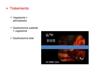 Tratamiento

 Vagotomía +
 piloroplastía

 Gastrectomía subtotal
 + vagotomía

 Gastrectomía total
 