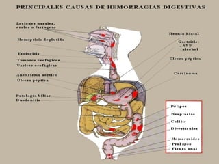 hemorragia digestiva