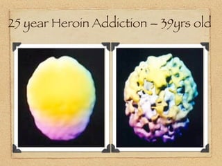 25 year Heroin Addiction – 39yrs old
 