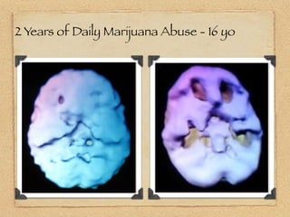 2 Years of Daily Marijuana Abuse - 16 yo
 
