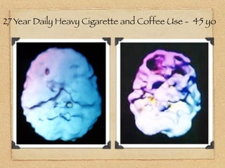 27 Year Daily Heavy Cigarette and Coffee Use - 45 yo
 