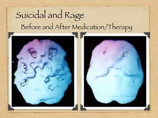 Suicidal and Rage
 Before and After Medication/Therapy
 