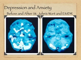 Depression and Anxiety
 Before and After St. John’s Wort and EMDR
 