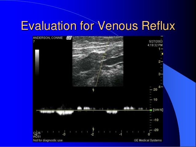 venous reflux ultrasound venous reflux ultrasound