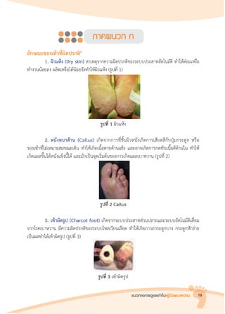 แนวทางการดูแลเท้าในผู้ป่วยเบาหวาน