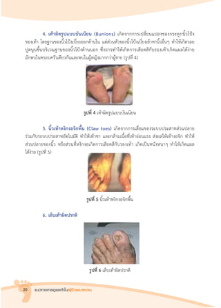 แนวทางการดูแลเท้าในผู้ป่วยเบาหวาน