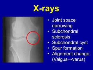 X-rays
• Joint space
narrowing
• Subchondral
sclerosis
• Subchondral cyst
• Spur formation
• Alignment change
(Valgus→varus)
 