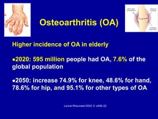 Osteoarthritis (OA)
Higher incidence of OA in elderly
⚫2020: 595 million people had OA, 7.6% of the
global population
⚫2050: increase 74.9% for knee, 48.6% for hand,
78.6% for hip, and 95.1% for other types of OA
Lancet Rheumatol 2023; 5: e508–22
 
