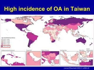 High incidence of OA in Taiwan
Lancet Rheumatol 2023; 5: e508–22
 