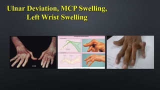 Ulnar Deviation, MCP Swelling,
Left Wrist Swelling
 