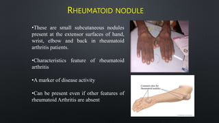 RHEUMATOID NODULE
•These are small subcutaneous nodules
present at the extensor surfaces of hand,
wrist, elbow and back in rheumatoid
arthritis patients.
•Characteristics feature of rheumatoid
arthritis
•A marker of disease activity
•Can be present even if other features of
rheumatoid Arthritis are absent
 