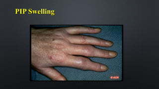 PIP Swelling
 