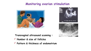 Monitoring ovarian stimulation
Transvaginal ultrasound scanning :
 Number & size of follicles
 Pattern & thickness of endometrium
 