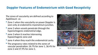 Doppler Features of Endometrium with Good Receptivity
The zones of vascularity are defined according to
Applebaum as:
 Zone 1 when the vascularity on power Doppler is
seen only at endometrio myometrium junction,
 zone 2 when vessels penetrate through the
hyperechogenic endometrial edge,
 zone 3 when it reaches intervening
hypoechogenic zone and
 zone 4 when they reach the endometrial cavity.
 The pregnancy rates related to the zones of
vascular penetration: 26.7% for zone 1, 36.4% for
zone 2 and 37.9% for zone 3.
 