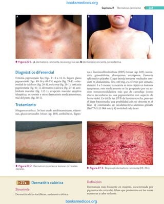 Capítulo 27 Dermatosis cenicienta 149
Diagnóstico diferencial
Eritema pigmentado ﬁjo (ﬁgs. 11-2 a 11-4), liquen plano
pigmentado (ﬁgs. 49-14 y 49-15), argiria (ﬁg. 29-1), enfer-
medad de Addison (ﬁg. 28-1), melasma (ﬁg. 26-1), urticaria
pigmentaria (ﬁg. 61-1), dermatitis calórica (ﬁg. 27-4), ami-
loidosis macular (ﬁg. 117-1), erupción macular eruptiva
idiopática, ocronosis y otras dermatosis medicamentosas,
mal del pinto (ﬁg. 30-5).
Tratamiento
Ninguno es eﬁcaz. Se han usado antihistamínicos, vitami-
nas, glucocorticoides (véase cap. 169), antibióticos, dapso-
na o diaminodifenilsulfona (DDS) (véase cap. 169), isonia-
zida, griseofulvina, cloroquinas, estrógenos, Fumaria
oﬃcinalis y placebo. El que brinda mejores resultados con-
siste en clofazimina, 50 a 100 mg, 2 a 3 veces por semana,
durante 3 a 5 meses; la mejoría es más rápida en lesiones
tempranas; este medicamento se ha propuesto por su ac-
ción inmunomoduladora más que de camuﬂaje (como
efecto secundario da una pigmentación con aspecto de
bronceado). Es útil la luz UVB de banda estrecha, pero no
el láser fraccionado; una posibilidad aún no descrita es el
láser Q conmutado de neodimio:itrio-aluminio-granate
(Nd:YAG) (1 064 nm) y Q-switched ruby laser.
 Figura 27-1. A. Dermatosis cenicienta, lesiones grisáceas. B. Dermatosis cenicienta, cerulodermia.
 Figura 27-2. Dermatosis cenicienta: lesiones circinadas
iniciales.
A B
 Figura 27-3. Biopsia de dermatosis cenicienta (HE, 20×).
27a  Dermatitis calórica
Sinonimia
Dermatitis de las tortilleras, melanosis calórica.
Deﬁnición
Dermatosis más frecuente en mujeres, caracterizada por
pigmentación reticular difusa que predomina en las zonas
expuestas a calor radiante.
Libros de Medicina en PDF [◢ ◤ BMV ◢ ◤]
booksmedicos.org
booksmedicos.org
 