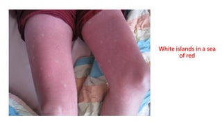 26
White islands in a sea
of red
 