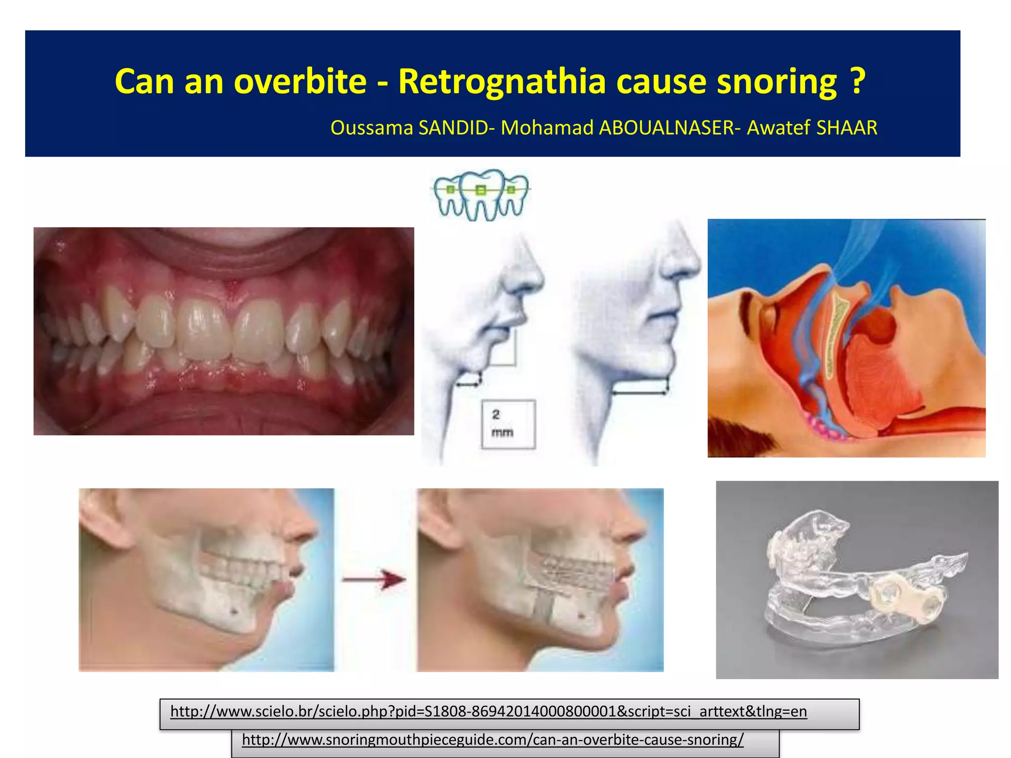 113 early treatments inorthodontics- classii division 2 malocclusion ...