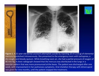 Figure	
  1.	
  A	
  21-­‐year-­‐old	
  dental	
  assistant	
  a1empted	
  suicide	
  by	
  injec8ng	
  10	
  ml	
  (135	
  g)	
  of	
  elemental	
  
mercury	
  (quicksilver)	
  intravenously.	
  She	
  presented	
  to	
  the	
  emergency	
  room	
  with	
  tachypnea,	
  a	
  
dry	
  cough,	
  and	
  bloody	
  sputum.	
  While	
  breathing	
  room	
  air,	
  she	
  had	
  a	
  par8al	
  pressure	
  of	
  oxygen	
  of	
  
86	
  mm	
  Hg.	
  A	
  chest	
  radiograph	
  showed	
  that	
  the	
  mercury	
  was	
  distributed	
  in	
  the	
  lungs	
  in	
  a	
  
vascular	
  pa1ern	
  that	
  was	
  more	
  pronounced	
  at	
  the	
  bases.	
  The	
  pa8ent	
  was	
  discharged	
  aNer	
  one	
  
week,	
  with	
  improvement	
  in	
  her	
  pulmonary	
  symptoms.	
  Oral	
  chela8on	
  therapy	
  with	
  dimercaprol	
  
was	
  given	
  for	
  nine	
  months,	
  un8l	
  the	
  pa8ent	
  stopped	
  the	
  treatment;	
  	
  
 