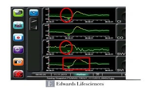 Pulse Contour Analysis: Riding the Wave | PPTX