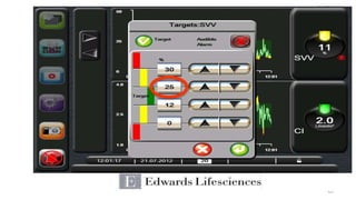 Pulse Contour Analysis: Riding the Wave | PPTX