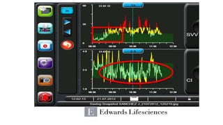 Pulse Contour Analysis: Riding the Wave | PPTX