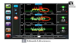 Pulse Contour Analysis: Riding the Wave | PPTX