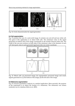 About array processing methods for image segmentation 33
Fig. 14. Circle characterization by signal generation
8.4 Cell segmentation
Fig. 15 presents the case of a real-world image. It contains one red cell and one white cell.
Our goal in this application is to detect both cells. The minimum value in the signal
generated on bottom side of the image corresponds to the frontier between both cells. The
width of the non-zero sections on both sides of the minimum value is the diameter of each
cell. Each peak value in each generated signal provides one center coordinate.
Fig. 15. Blood cells: (a) processed image; (b) superposition processed image and result;
signals generated on: (c) the bottom of the image; (d) the left side of the image.
8.5 Melanoma segmentation
Fig. 16 concerns quantitative analysis in a medical application. More precisely, the purpose
of the experiment is to detect the frontier of a melanoma. The melanoma was chosen
randomly out of a database (Stolz et al., 2003).
 