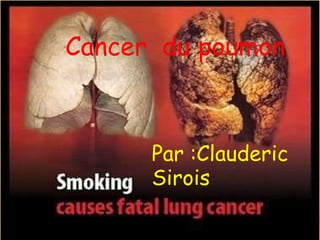     Cancer  du poumon  Par :Clauderic Sirois  