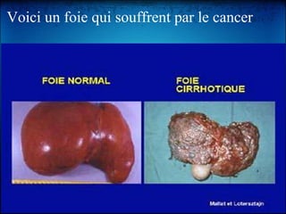 Voici un foie qui souffrent par le cancer     
