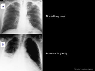 Normal lung x-ray
Abnormal lung x-ray
Not actual x-ray, but pretty close
 