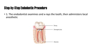 Step-by-Step Endodontic Procedure
• 1. The endodontist examines and x-rays the tooth, then administers local
anesthetic
 