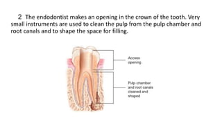 2 The endodontist makes an opening in the crown of the tooth. Very
small instruments are used to clean the pulp from the pulp chamber and
root canals and to shape the space for filling.
 