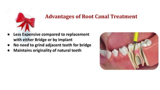 Advantages of Root Canal Treatment
● Less Expensive compared to replacement
with either Bridge or by implant
● No need to grind adjacent teeth for bridge
● Maintains originality of natural teeth
 
