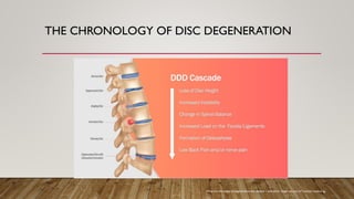 THE CHRONOLOGY OF DISC DEGENERATION
What are the stages of degenerative disc disease – and which ‘stage’ are you in? | stöckli medical ag.
 